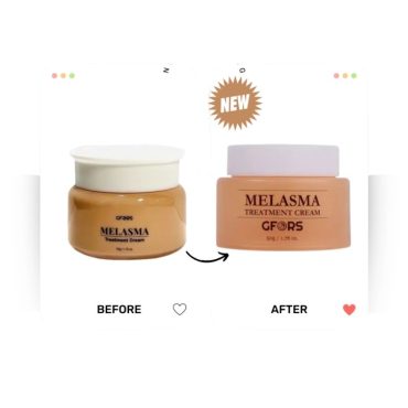 GFORS Melasma Treatment Cream 50gm